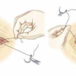 Hymenoplasty in Pakistan