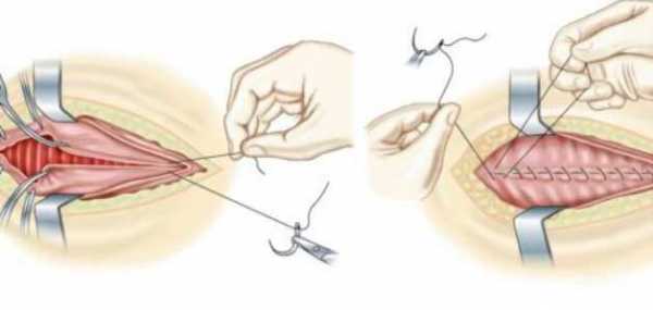 Hymenoplasty in Pakistan