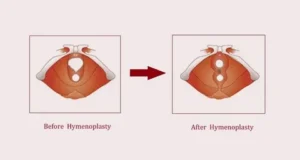 hymen repair in Pakistan