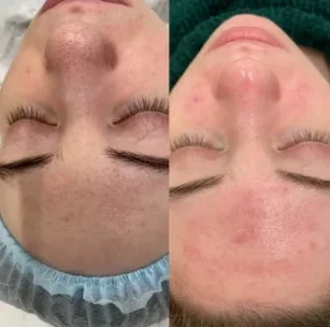 Hydra facial cost in Pakistan