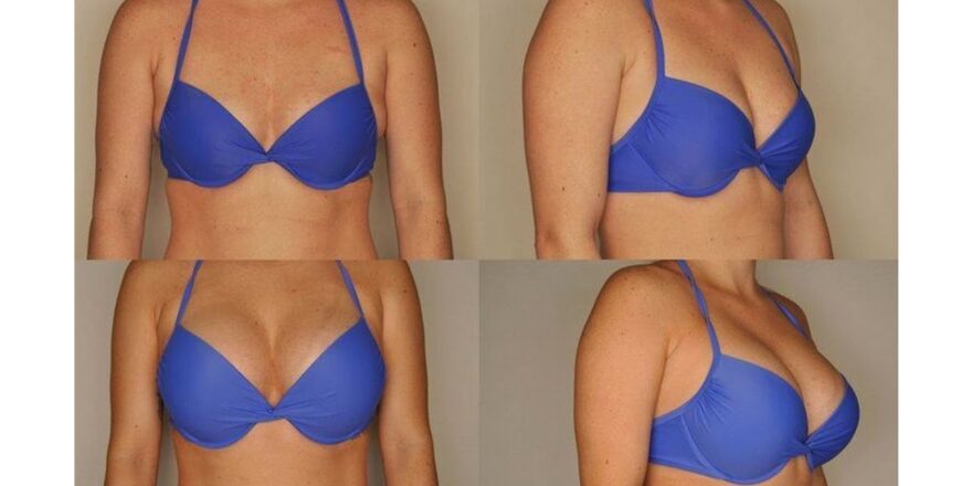 Breast Lifting in Pakistan