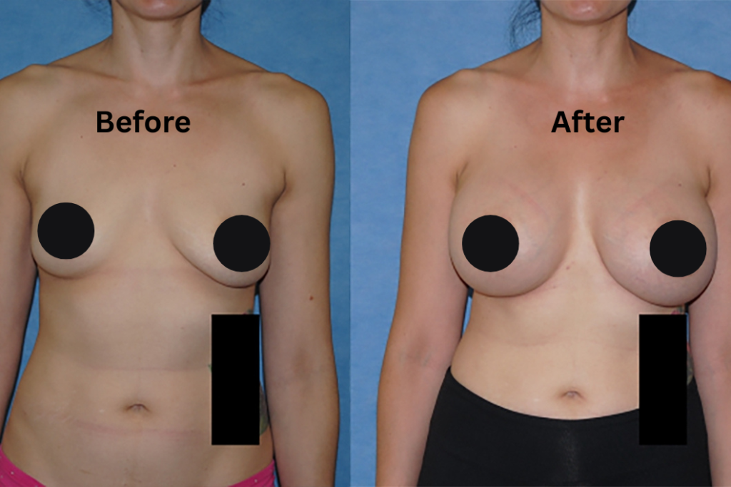 Breast Lifting in Pakistan