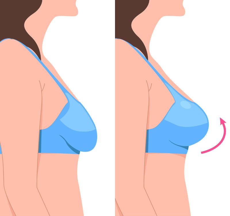 Non-Surgical Breast Lifting