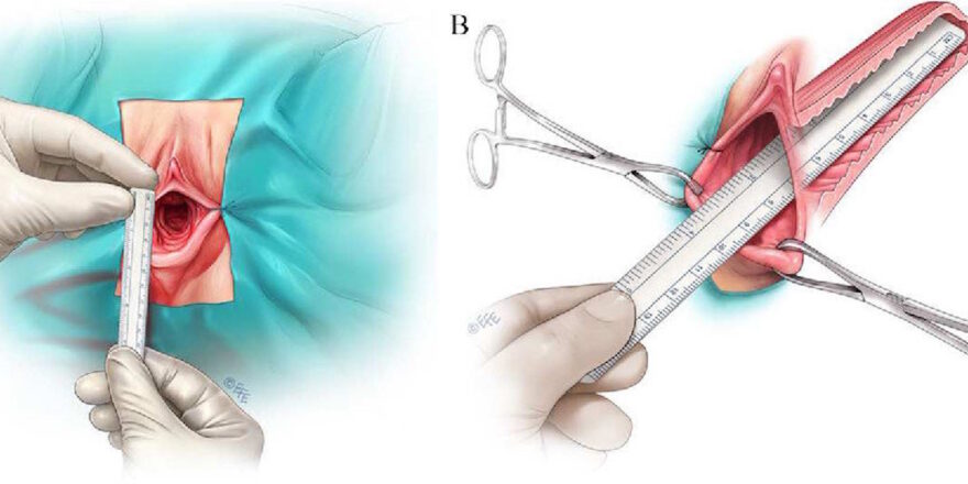 Hymen Repair Surgery Explained by Dr Shafaq Ramay