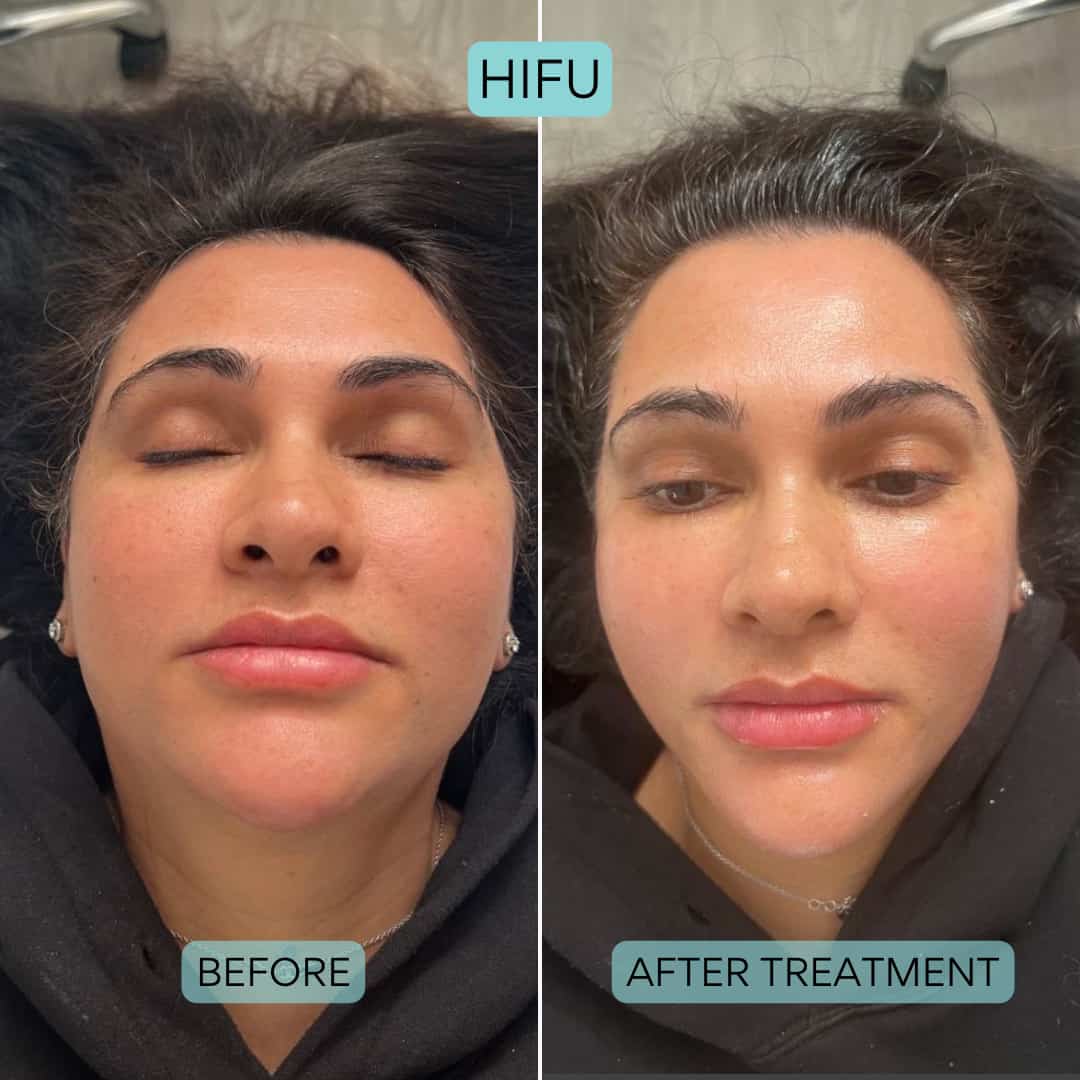 HIFU Face Lift