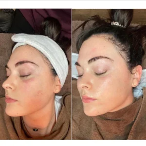 HydraFacial