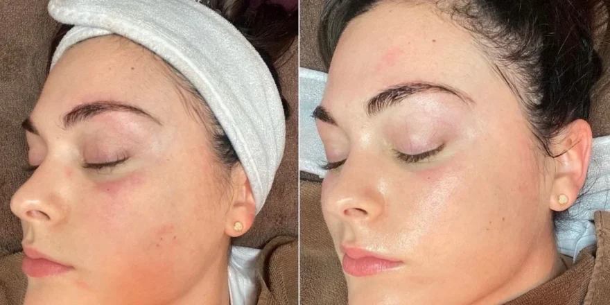 HydraFacial