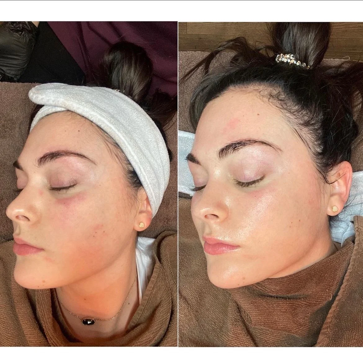 HydraFacial