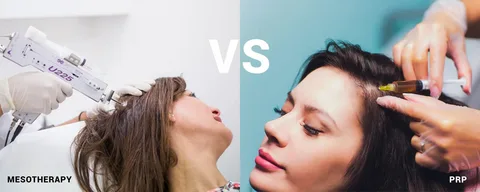 PRP vs Mesotherapy for Hair Growth