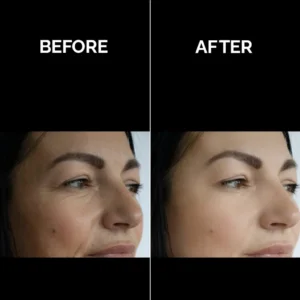 Dermal Fillers
