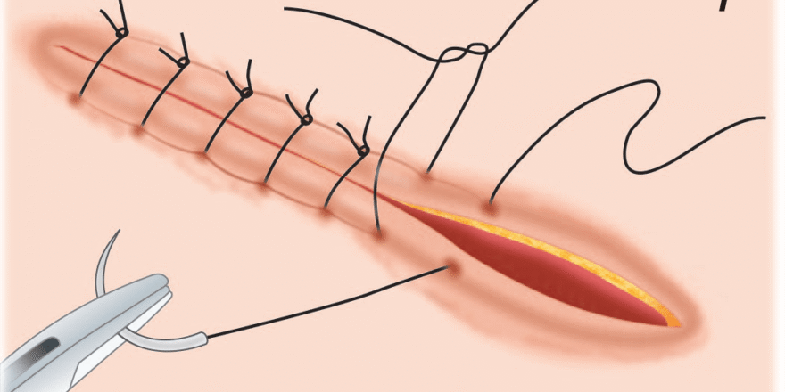 Labiaplasty Surgery in Pakistan