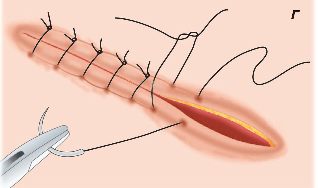 Labiaplasty Surgery in Pakistan