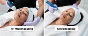 RF Microneedling