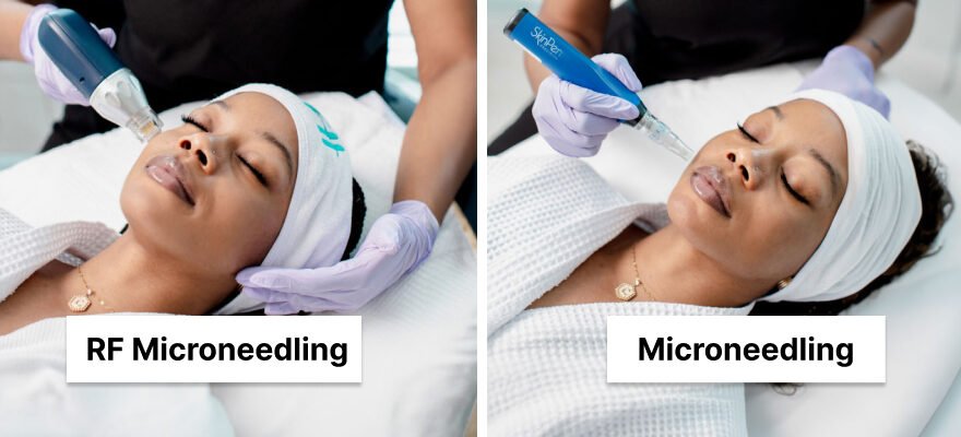 RF Microneedling