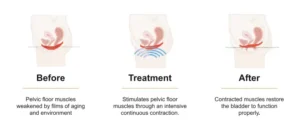 Non-Surgical Female Incontinence Treatment
