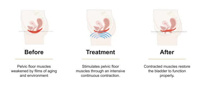 Non-Surgical Female Incontinence Treatment