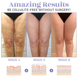 Cellulite Reduction Islamabad | Non-Invasive Smooth Skin
