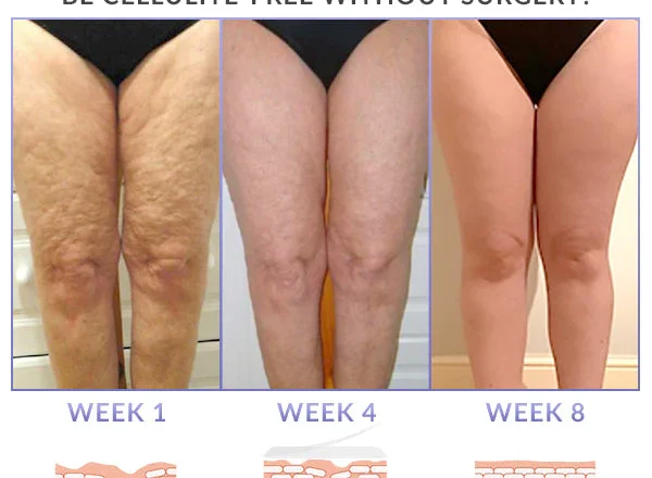 Cellulite Reduction Islamabad | Non-Invasive Smooth Skin