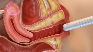 Non-Surgical Postpartum Vaginal Rejuvenation