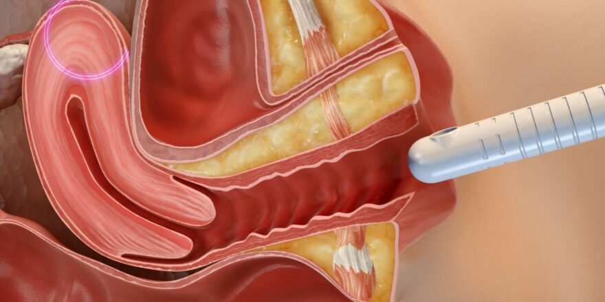 Non-Surgical Postpartum Vaginal Rejuvenation