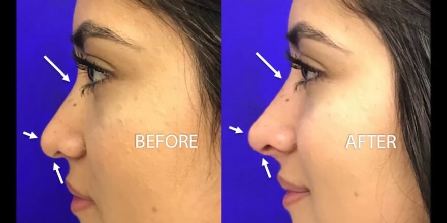 Non Surgical Rhinoplasty Islamabad | Liquid Nose Job Benefit