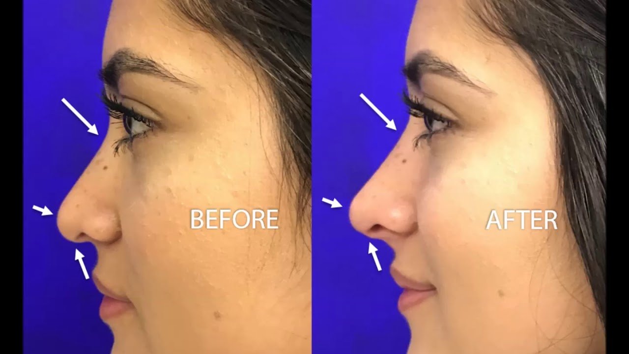 Non Surgical Rhinoplasty Islamabad | Liquid Nose Job Benefit