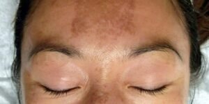 melasma treatment in Islamabad
