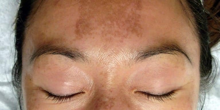 melasma treatment in Islamabad