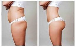 Cellulite Reduction Islamabad