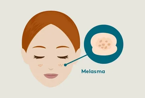 melasma treatment in Islamabad