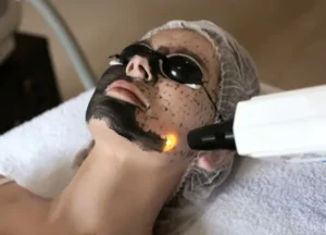 Carbon Laser Peel Islamabad