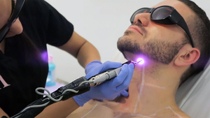 Microneedling Treatment Islamabad