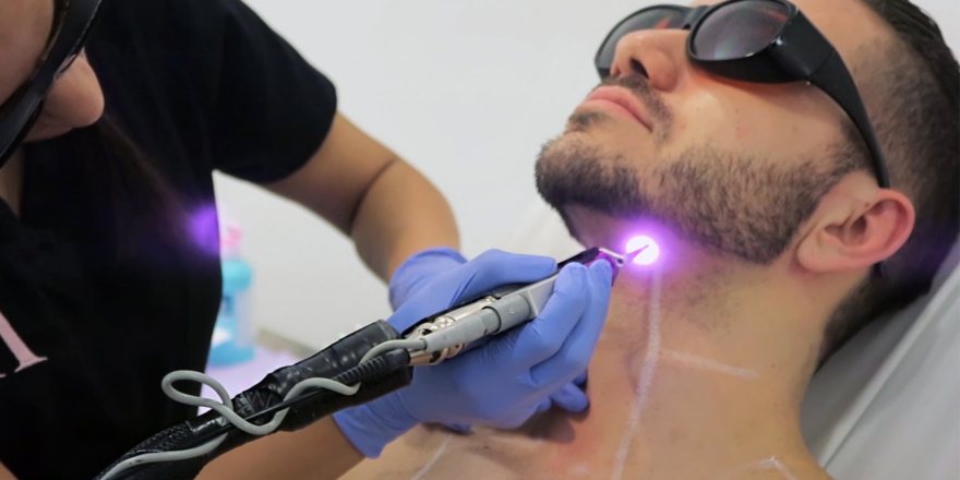 Microneedling Treatment Islamabad